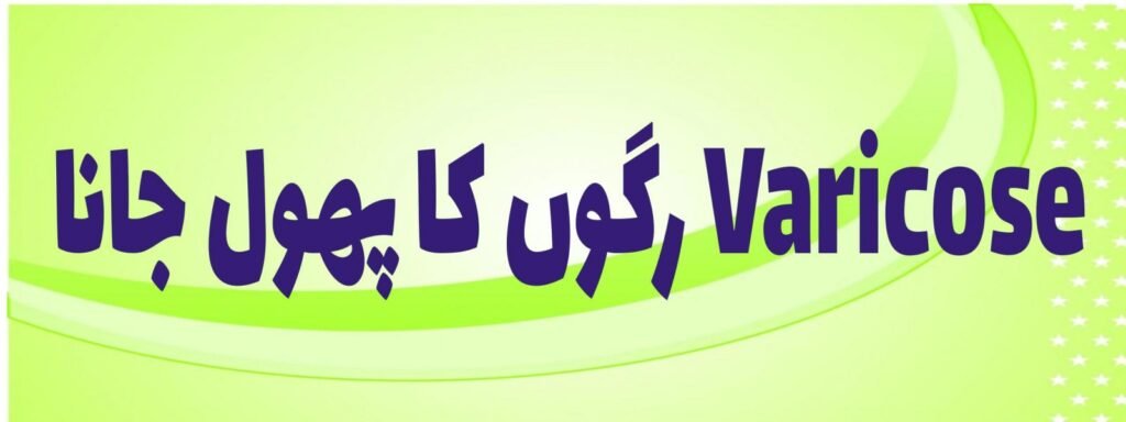 کا پھول جانا Varicose