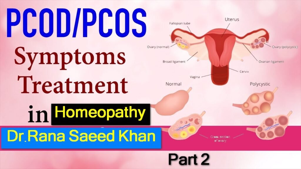 Pcos2