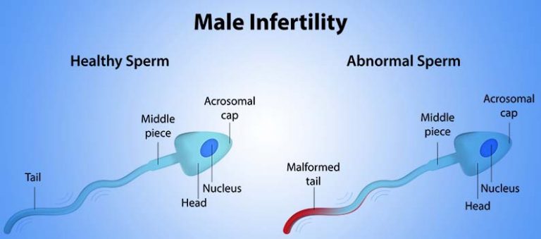 بانجھ پن/infertility