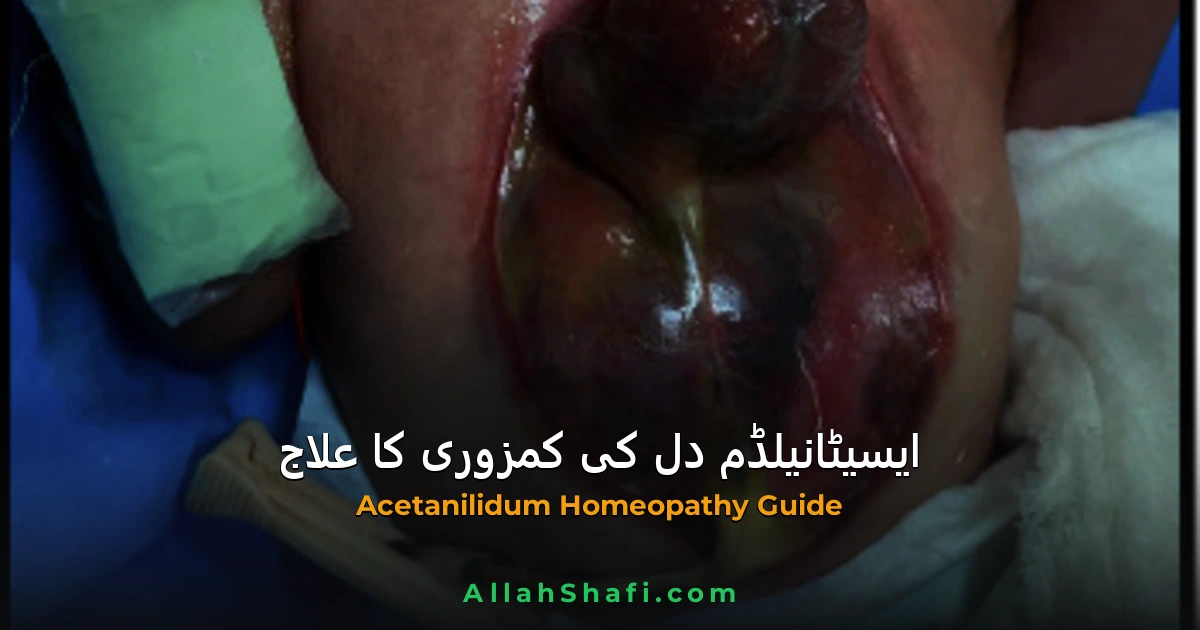 ایسیٹانیلڈم (Acetanilidum) — دل کی کمزوری، نیلاہٹ اور بخار کا ہومیوپیتھک علاج