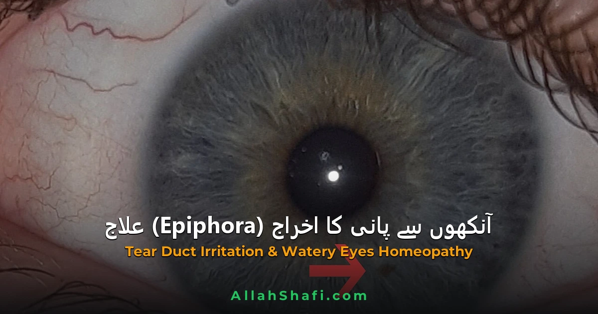 EPIPHORA/آنکھوں سے پانی کا اخراج
