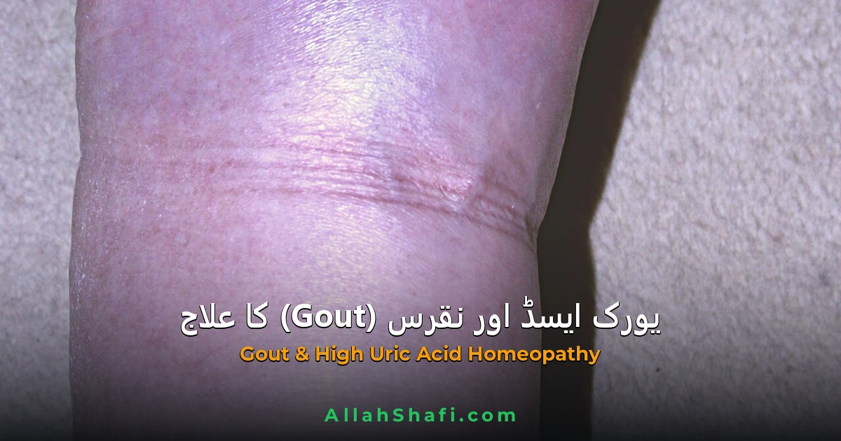 یورک ایسڈ، جوڑوں کے درد اور نقرس (Gout) کا مکمل ہومیوپیتھک علاج