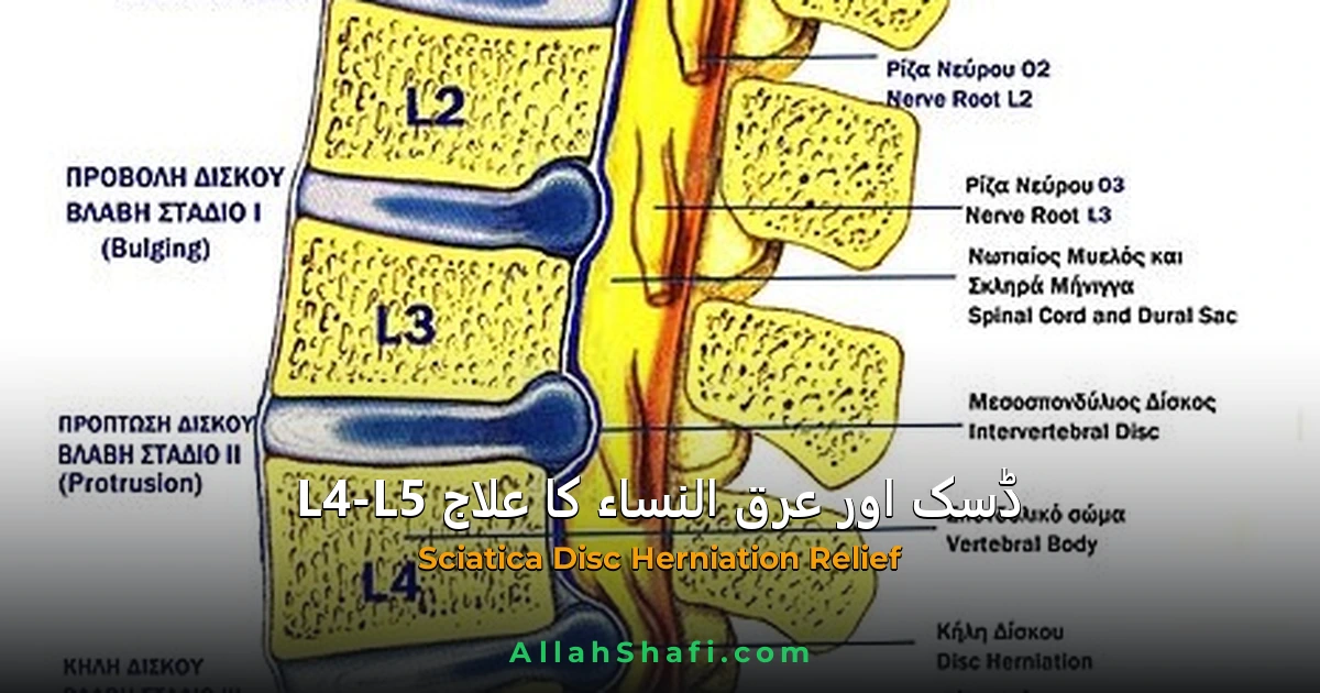 سائیکاٹیکا اور عرق النساء کے درد کا علاج — L4-L5 ڈسک، علامات و شفا