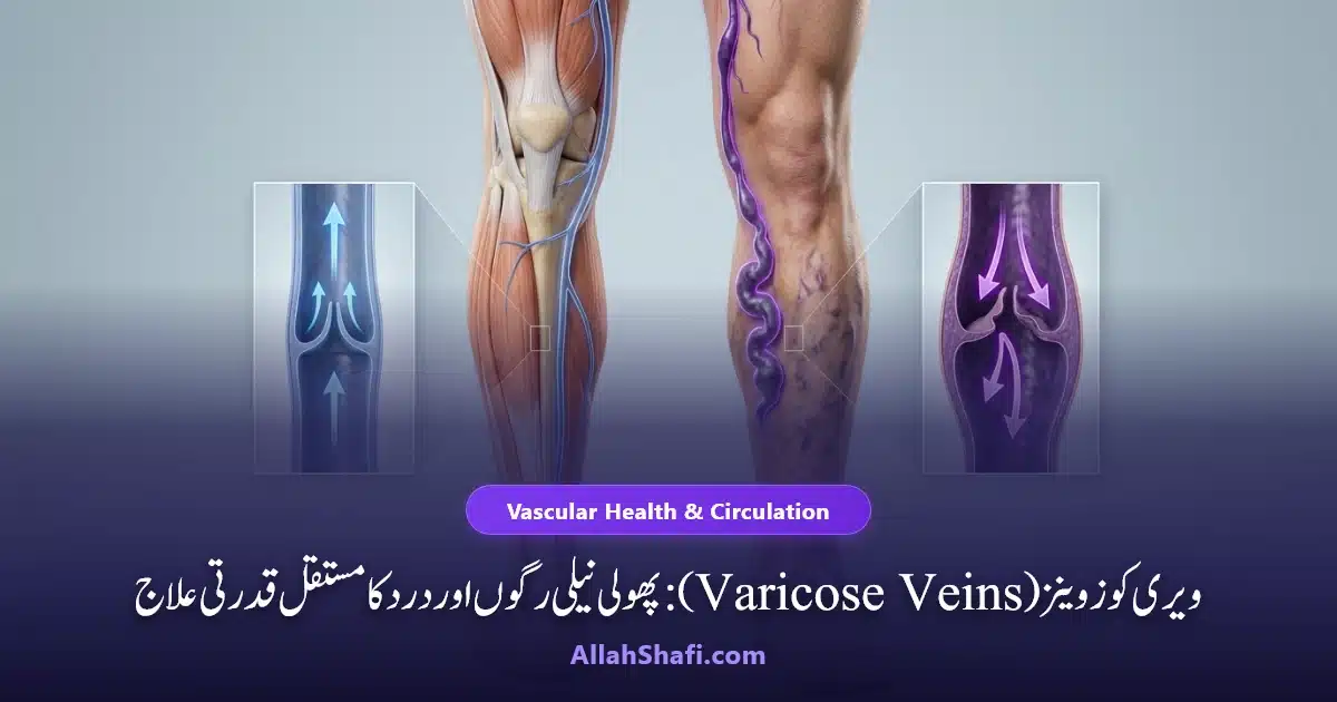 ویری کوز وینز اسباب علامات اور ہومیوپیتھک طریقہ شفا