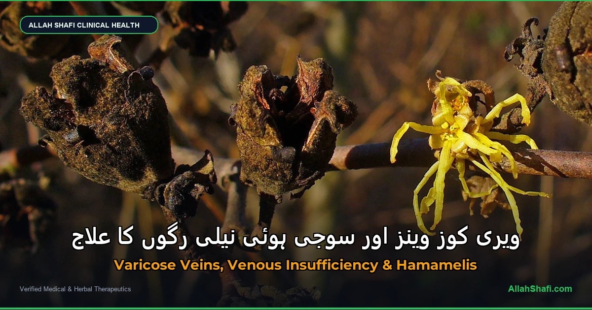 ویری کوز وینز اور سوجی ہوئی نیلی رگوں کا علاج