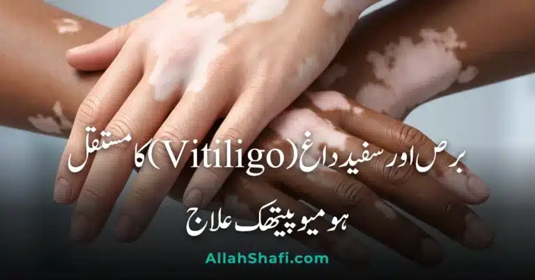 برص اور سفید داغ (Vitiligo) کا مستقل ہومیوپیتھک علاج