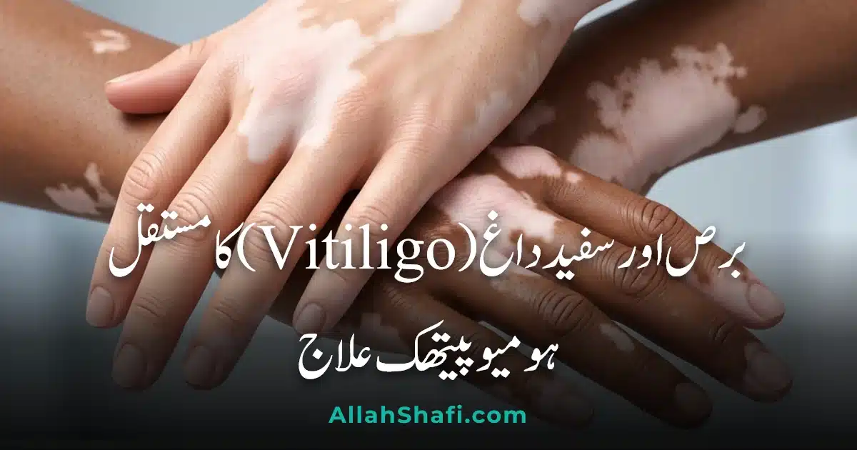 vitiligo ur feat