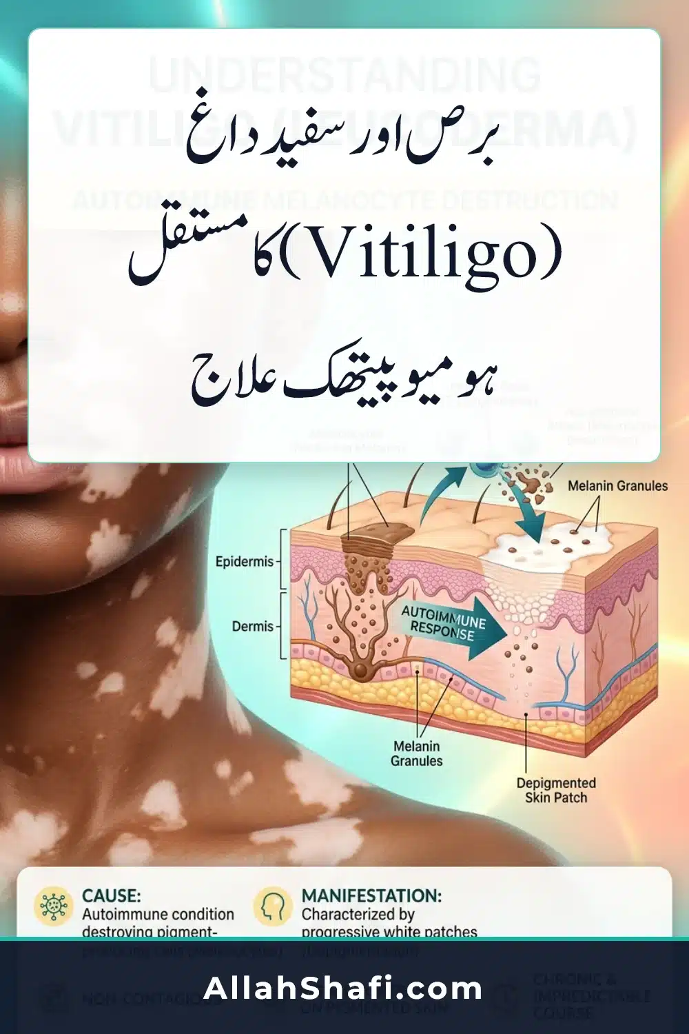 برص اور سفید داغ (Vitiligo) کا مستقل ہومیوپیتھک علاج برص اور سفید داغ کا مستقل ہومیوپیتھک علاج Vitiligo Leucoderma Homeopathic Treatment Urdu infographic pin