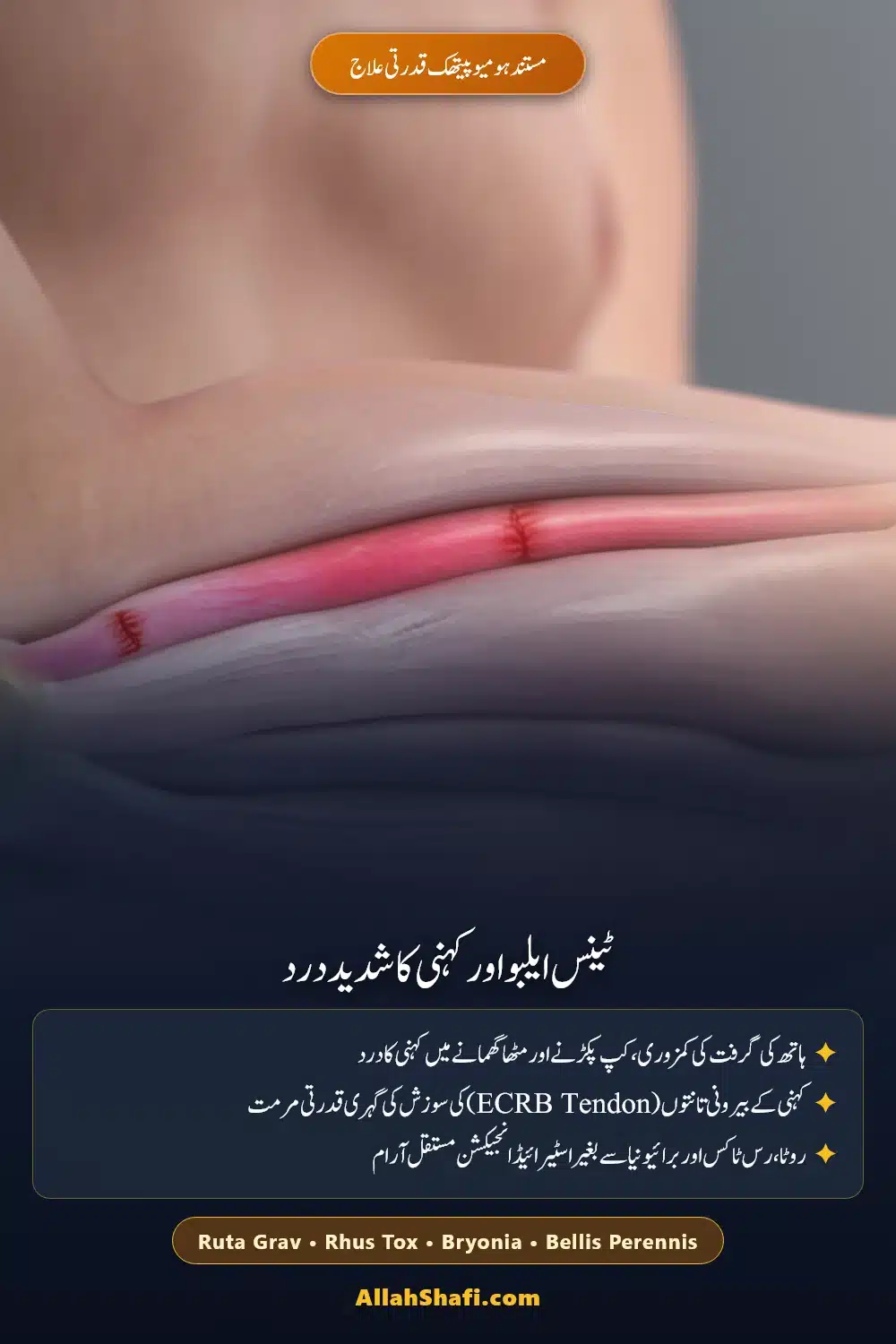 ٹینس ایلبو اور کہنی کے درد کا ہومیوپیتھک علاج پن
